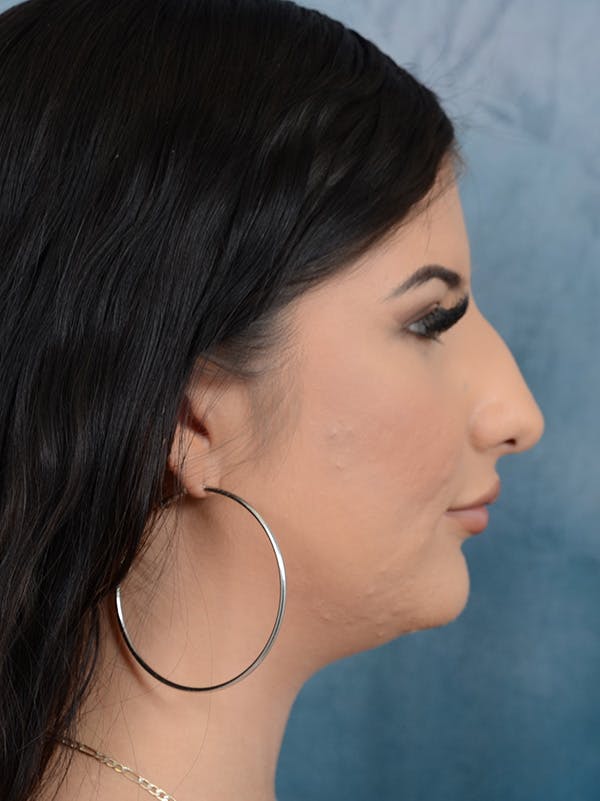 Rhinoplasty Before & After Gallery - Patient 360115 - Image 9