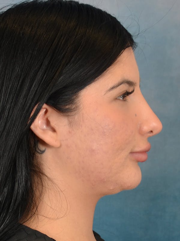 Rhinoplasty Before & After Gallery - Patient 360115 - Image 10