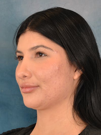 Rhinoplasty Before & After Gallery - Patient 360115 - Image 4