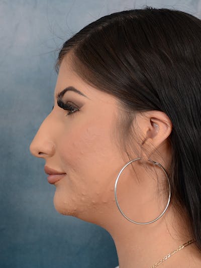 Rhinoplasty Before & After Gallery - Patient 360115 - Image 1