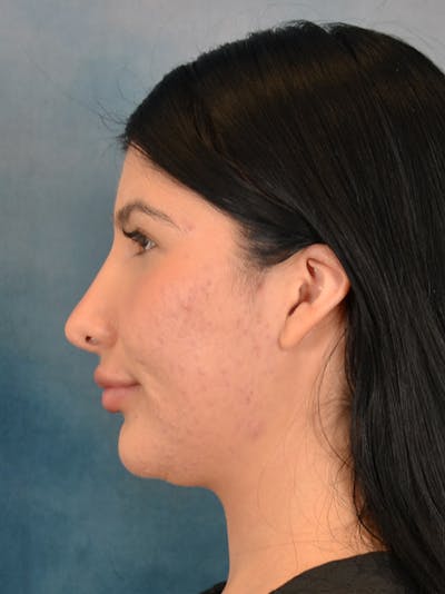 Rhinoplasty Before & After Gallery - Patient 360115 - Image 2