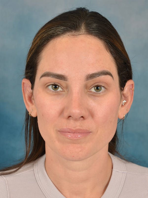 Rhinoplasty Before & After Gallery - Patient 223643 - Image 6