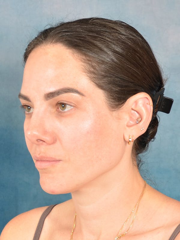 Rhinoplasty Before & After Gallery - Patient 223643 - Image 3