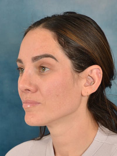 Rhinoplasty Before & After Gallery - Patient 223643 - Image 4