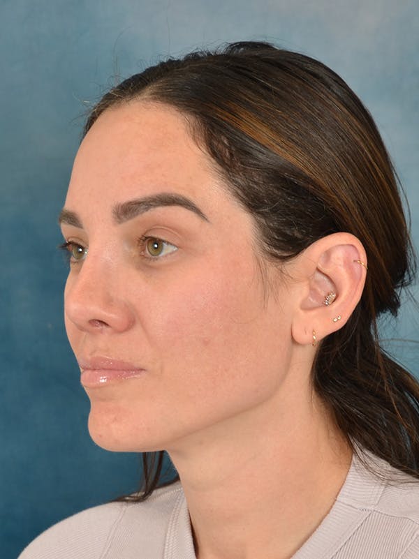Rhinoplasty Before & After Gallery - Patient 223643 - Image 4