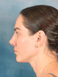Rhinoplasty Before & After Gallery - Patient 223643 - Image 1
