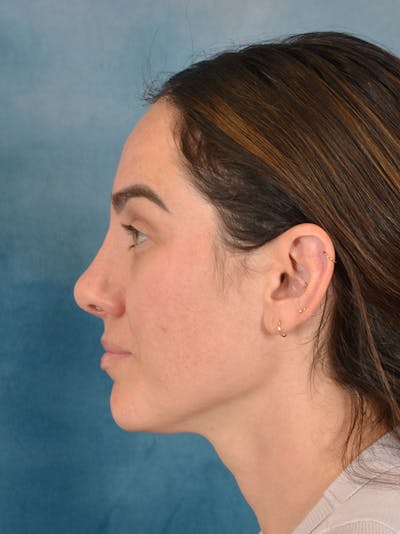 Rhinoplasty Before & After Gallery - Patient 223643 - Image 2