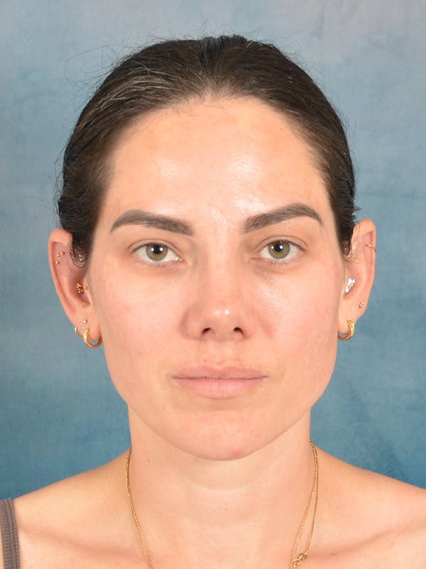 Rhinoplasty Before & After Gallery - Patient 223643 - Image 5