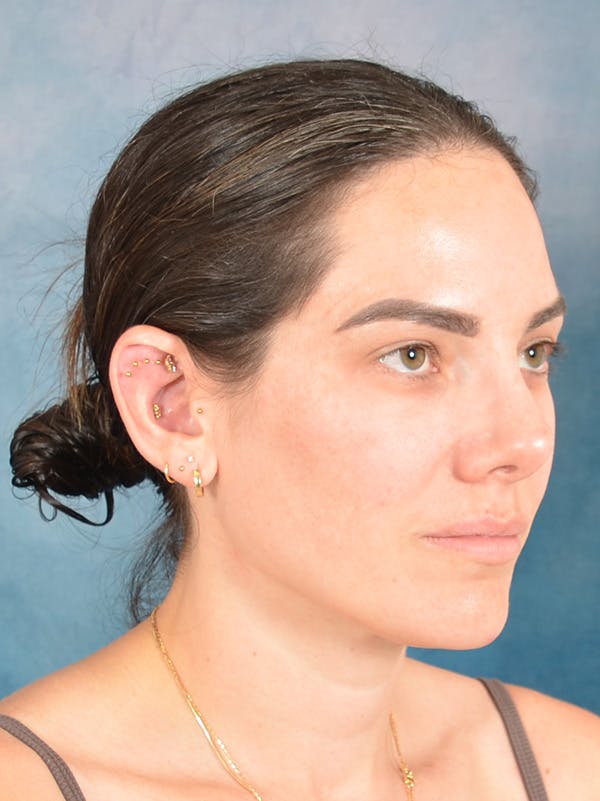 Rhinoplasty Before & After Gallery - Patient 223643 - Image 7