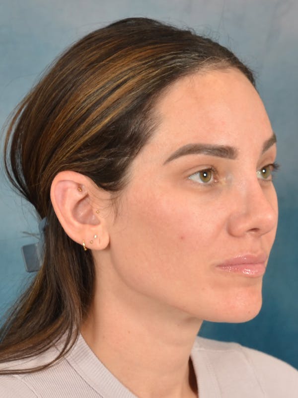 Rhinoplasty Before & After Gallery - Patient 223643 - Image 8