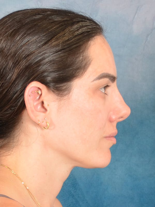 Rhinoplasty Before & After Gallery - Patient 223643 - Image 9