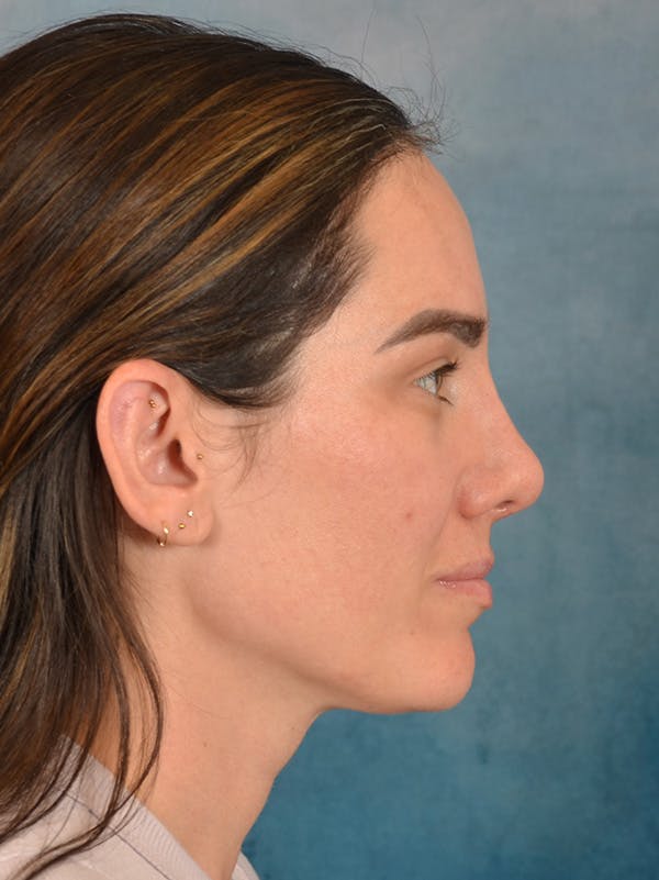 Rhinoplasty Before & After Gallery - Patient 223643 - Image 10