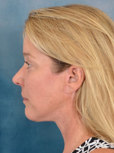 Laser Skin Resurfacing Before & After Gallery - Patient 242204 - Image 10