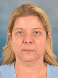 Laser Skin Resurfacing Before & After Gallery - Patient 242204 - Image 1