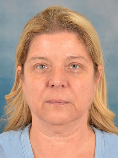 Laser Skin Resurfacing Before & After Gallery - Patient 242204 - Image 1