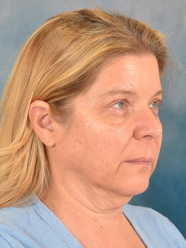 Laser Skin Resurfacing Before & After Gallery - Patient 242204 - Image 5
