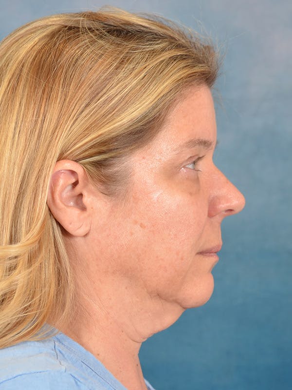 Laser Skin Resurfacing Before & After Gallery - Patient 242204 - Image 7