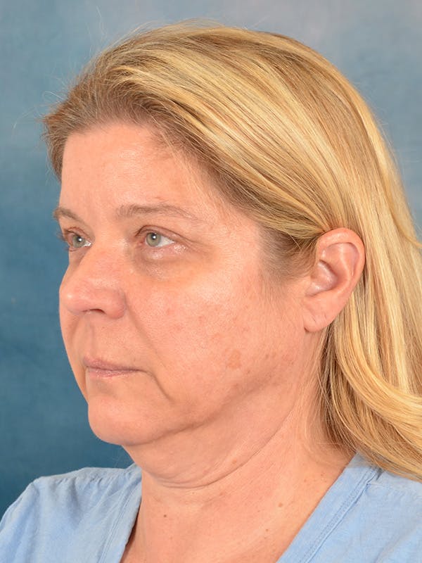 Laser Skin Resurfacing Before & After Gallery - Patient 242204 - Image 3