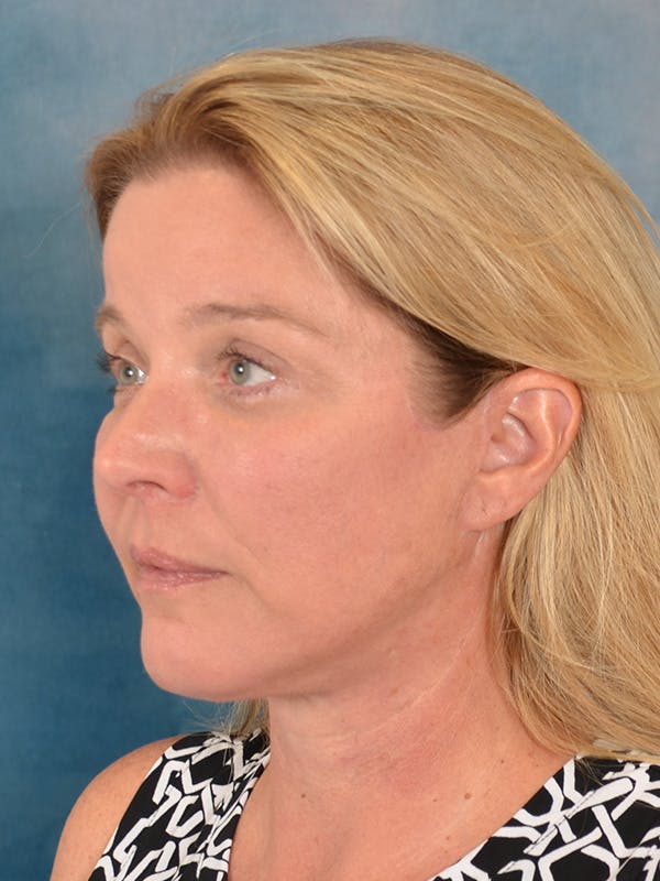 Laser Skin Resurfacing Before & After Gallery - Patient 242204 - Image 4