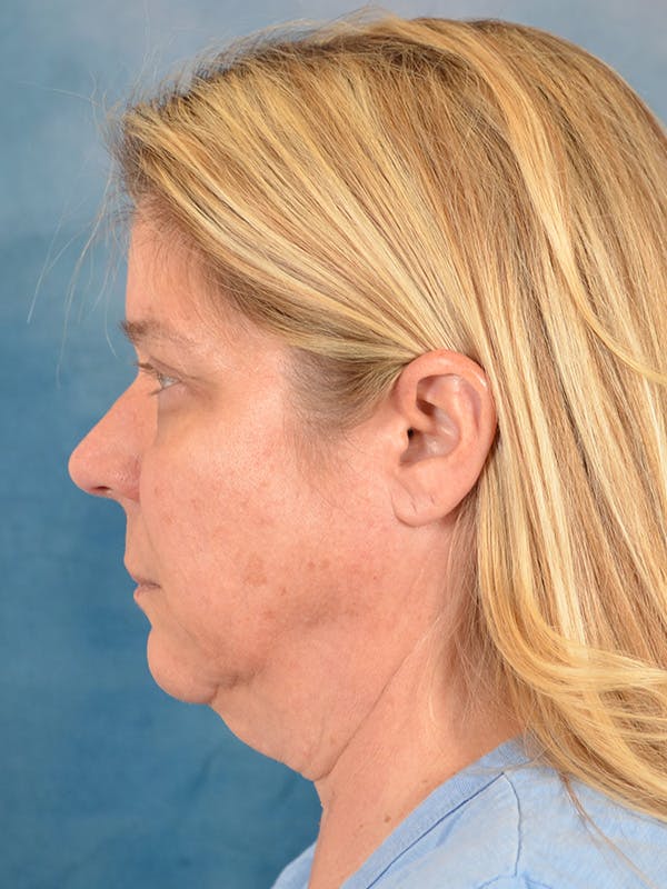 Laser Skin Resurfacing Before & After Gallery - Patient 242204 - Image 9
