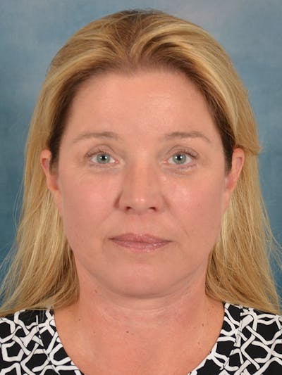 Laser Skin Resurfacing Before & After Gallery - Patient 242204 - Image 2