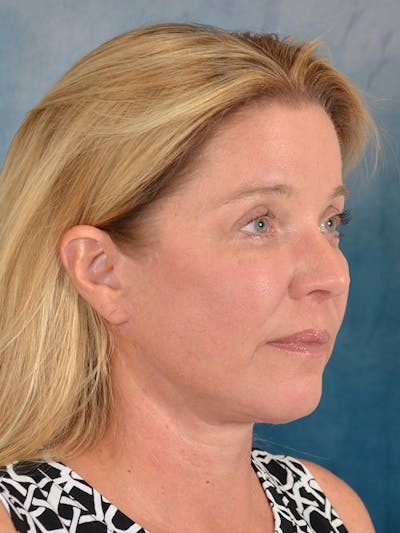Laser Skin Resurfacing Before & After Gallery - Patient 242204 - Image 6