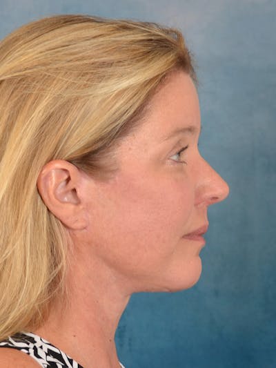 Laser Skin Resurfacing Before & After Gallery - Patient 242204 - Image 8