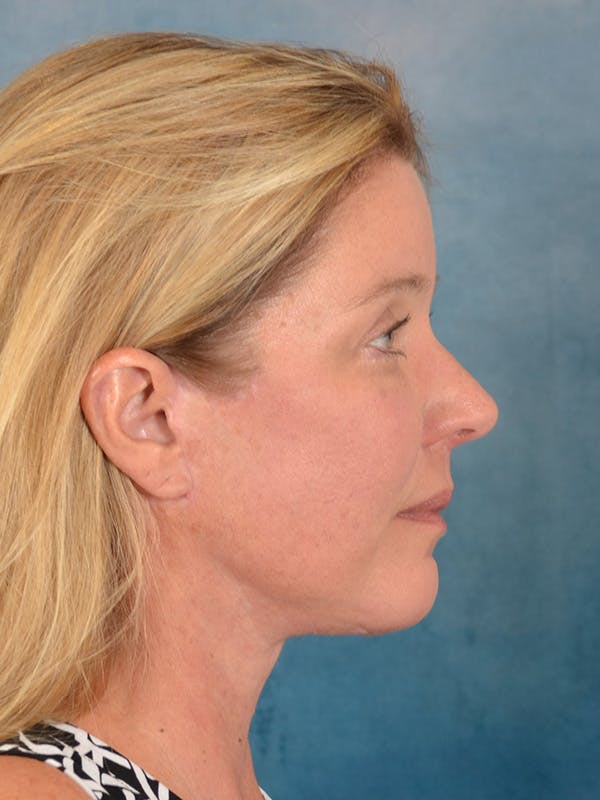 Laser Skin Resurfacing Before & After Gallery - Patient 242204 - Image 8