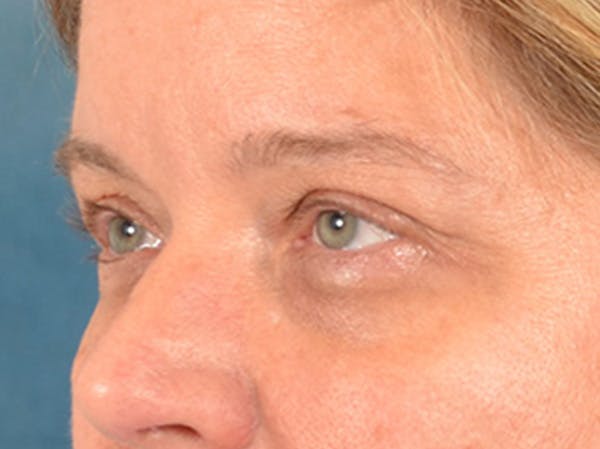 Eyelid Lift Before & After Gallery - Patient 340900 - Image 7