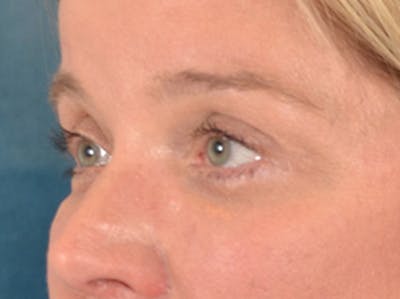 Eyelid Lift Before & After Gallery - Patient 340900 - Image 8
