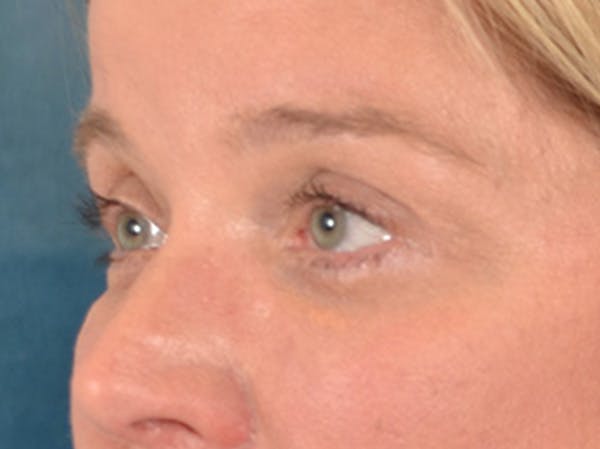 Eyelid Lift Before & After Gallery - Patient 340900 - Image 8