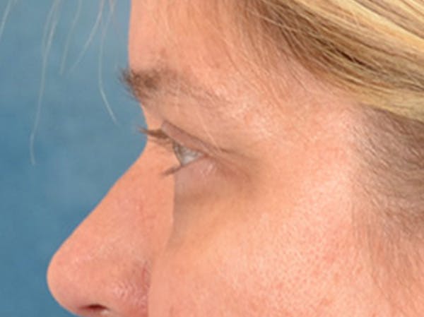 Eyelid Lift Before & After Gallery - Patient 340900 - Image 9