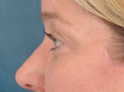 Eyelid Lift Before & After Gallery - Patient 340900 - Image 10