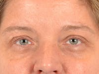 Eyelid Lift Before & After Gallery - Patient 340900 - Image 1