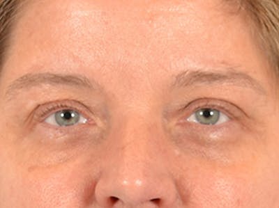 Eyelid Lift Before & After Gallery - Patient 340900 - Image 1