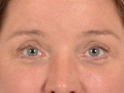 Eyelid Lift Before & After Gallery - Patient 340900 - Image 2