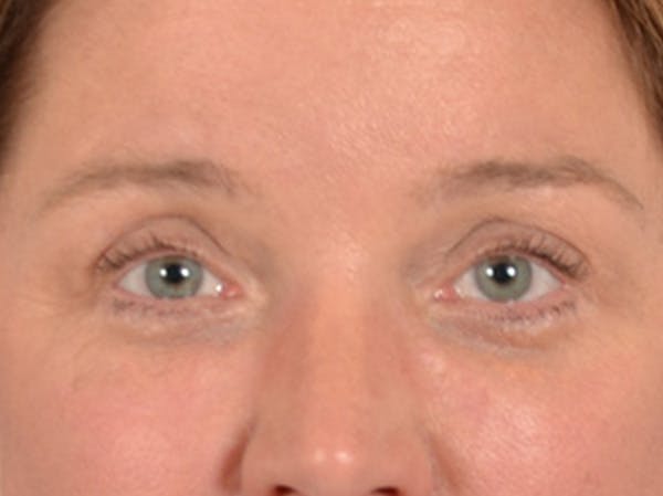 Eyelid Lift Before & After Gallery - Patient 340900 - Image 2