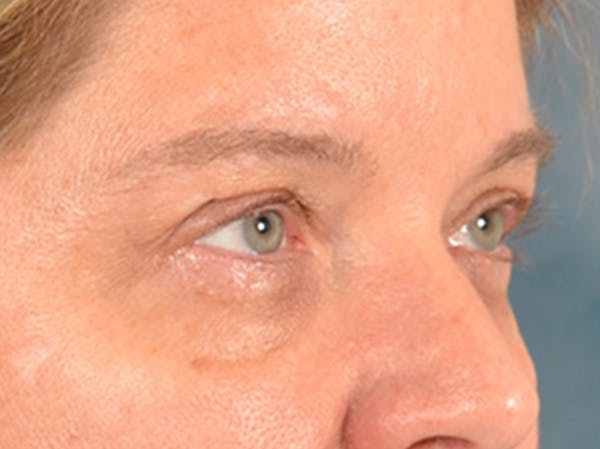 Eyelid Lift Before & After Gallery - Patient 340900 - Image 3