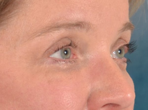 Eyelid Lift Before & After Gallery - Patient 340900 - Image 4
