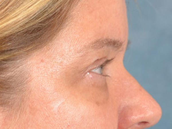 Eyelid Lift Before & After Gallery - Patient 340900 - Image 5