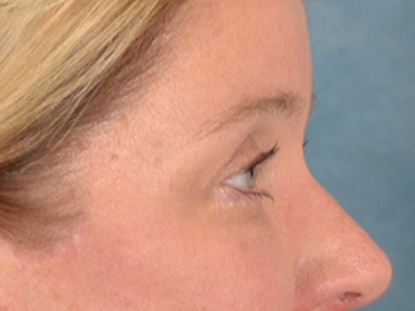 Eyelid Lift Before & After Gallery - Patient 340900 - Image 6