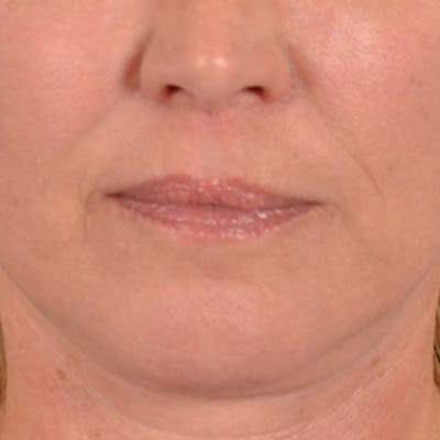 Lip Lift Before & After Gallery - Patient 191631 - Image 2