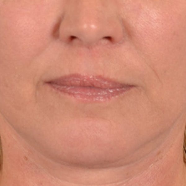 Lip Lift Before & After Gallery - Patient 191631 - Image 2