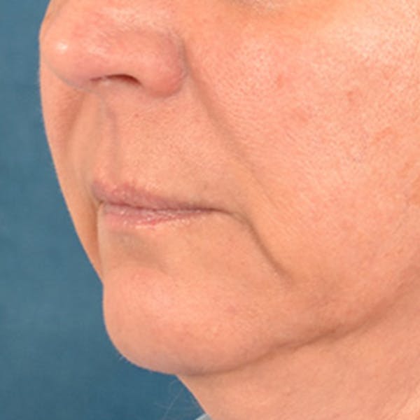 Lip Lift Before & After Gallery - Patient 191631 - Image 7