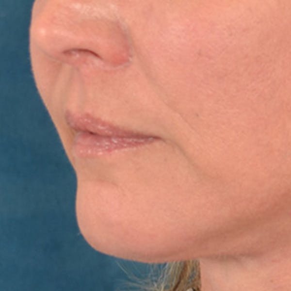 Lip Lift Before & After Gallery - Patient 191631 - Image 8