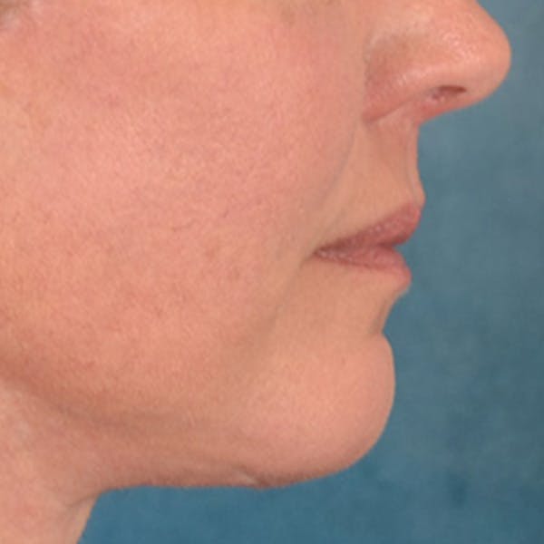 Lip Lift Before & After Gallery - Patient 191631 - Image 6