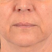 Lip Lift Before & After Gallery - Patient 191631 - Image 1