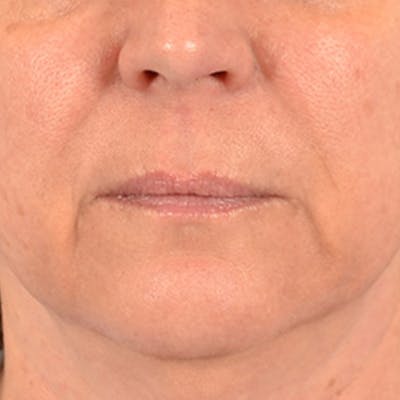 Lip Lift Before & After Gallery - Patient 191631 - Image 1