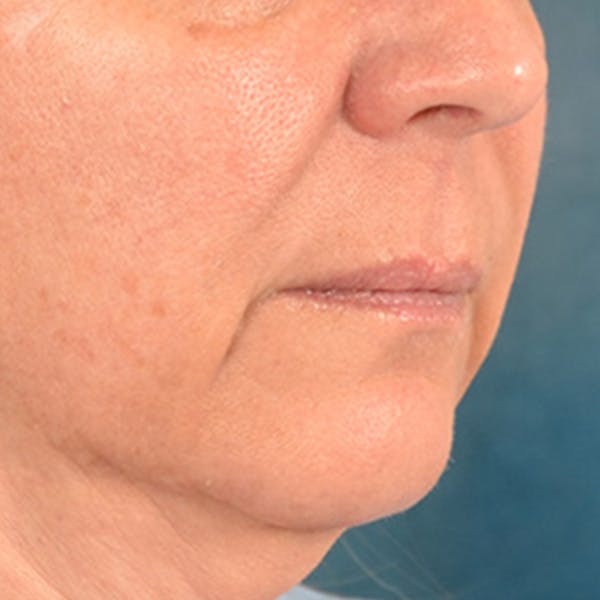 Lip Lift Before & After Gallery - Patient 191631 - Image 3
