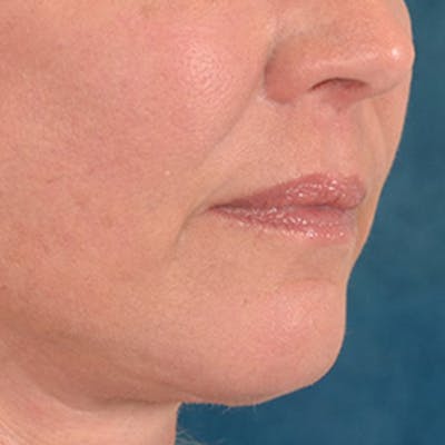 Lip Lift Before & After Gallery - Patient 191631 - Image 4